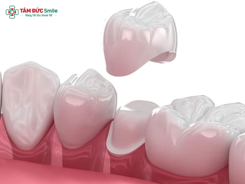 Bọc răng sứ sinh học là gì? Cấu tạo, đặc điểm và ưu nhược điểm
