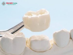 Bọc răng sứ thời gian được bao lâu? Tuổi thọ và độ bền theo năm