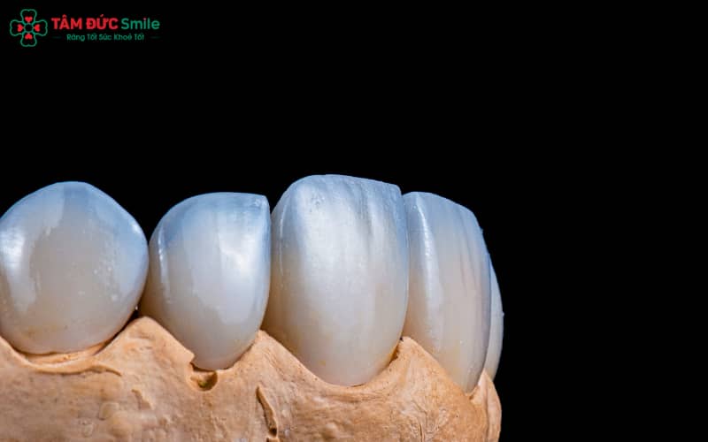 Tuổi thọ răng sứ trung bình từ 10–20 năm, thậm chí lâu hơn nếu được chế tác chuẩn và chăm sóc đúng cách