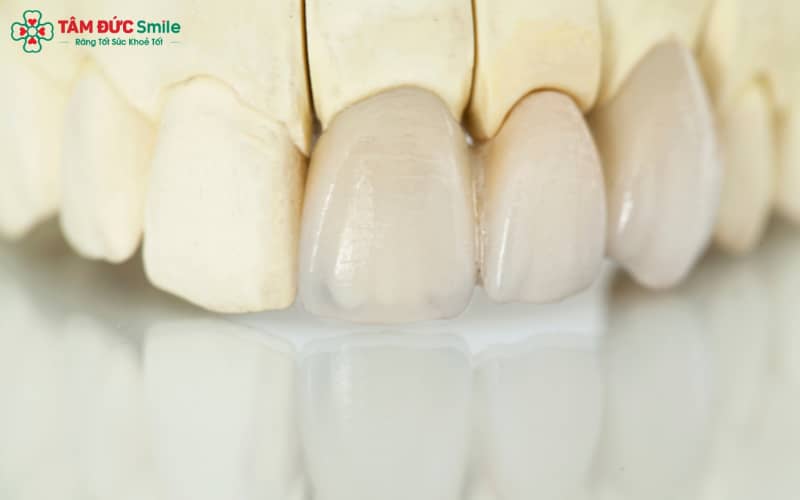 Độ bền răng sứ phụ thuộc vào chất liệu sứ, tay nghề bác sĩ, cách chăm sóc và thói quen sinh hoạt hằng ngày