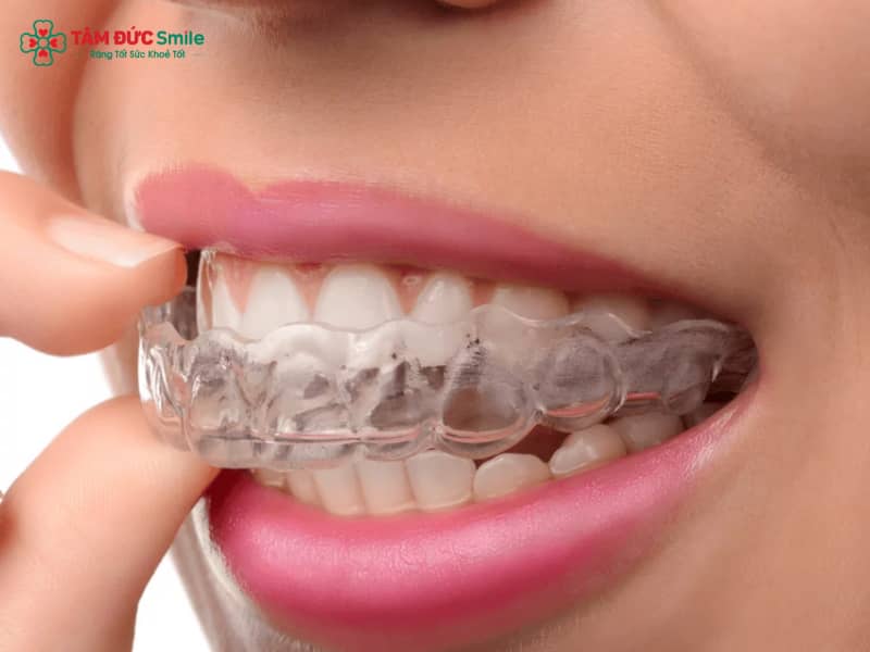 Cách sử dụng niềng răng trong suốt đúng chuẩn