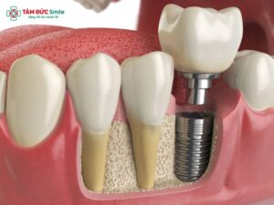 Cấy ghép Implant trong ngày là gì? Ưu điểm vượt trội tại Tâm Đức Smile