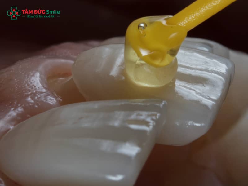 Dán răng sứ có tốt không? Ưu nhược điểm và độ bền của mặt dán sứ