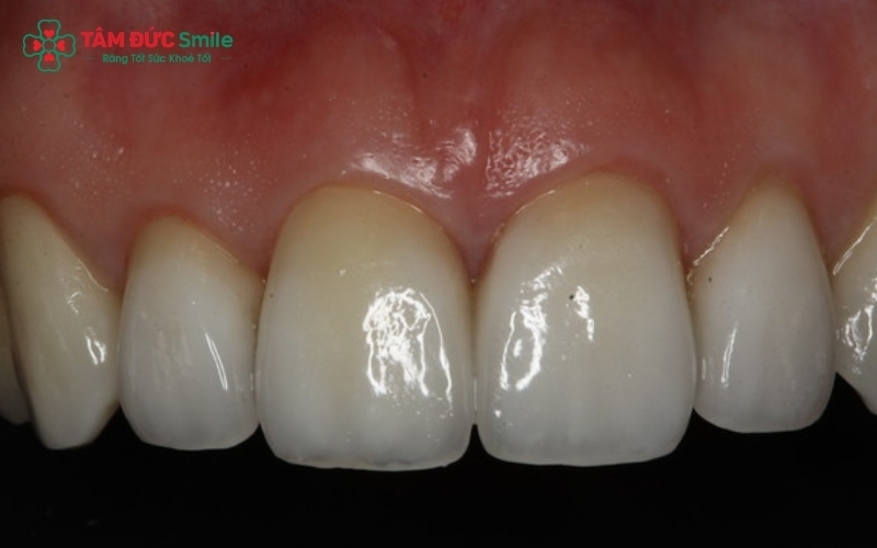 Trường hợp dán Veneer 2 răng cửa nhiễm màu, giúp mang lại diện mạo nụ cười cân đối và hài hòa nhất.