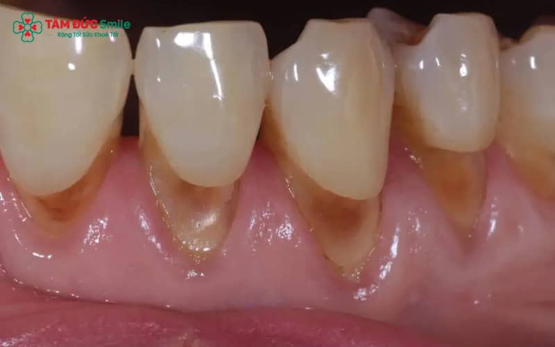 Nguyên nhân răng sứ bị hở thường do kỹ thuật bọc răng sai tỉ lệ, vật liệu kém chất lượng, hoặc chăm sóc sau bọc chưa đúng