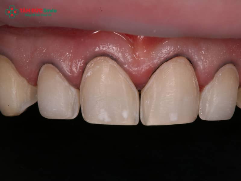 Dấu hiệu răng sứ bị hở? Nguyên nhân, hậu quả và cách khắc phục