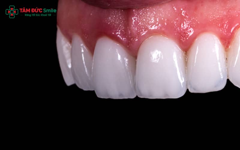 Răng sứ cao cấp là loại phục hình thẩm mỹ chất lượng cao, độ bền và màu sắc tự nhiên, bảo tồn răng thật tối đa