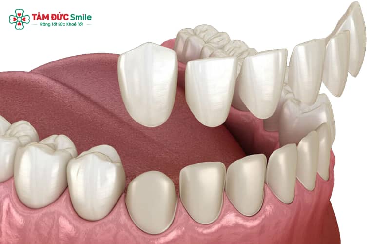Răng sứ Zirconia cao cấp: chắc khỏe, thẩm mỹ, khả năng tương thích sinh học cao và tuổi thọ lâu dài