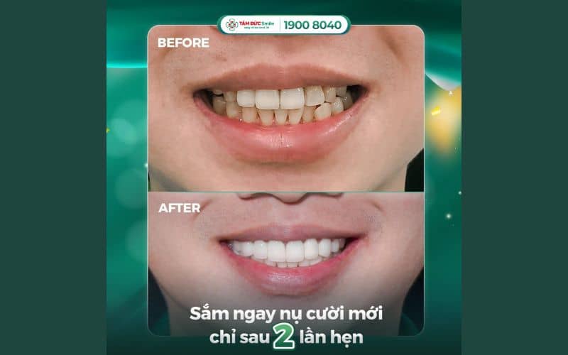 Răng sứ cao cấp mang lại nụ cười tự nhiên, độ bền lâu dài, an toàn sinh học và tiện lợi trong chăm sóc hàng ngày.