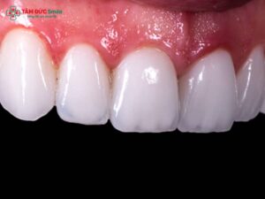 Các dòng răng sứ cao cấp tốt nhất hiện nay tại Nha khoa Tâm Đức Smile