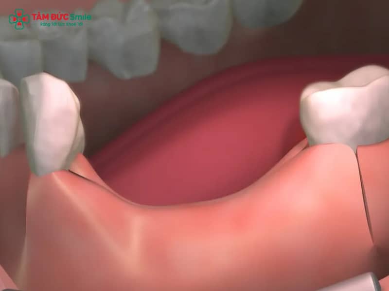Hậu quả mất răng: Tiêu xương hàm, hóp má, sai khớp cắn, giải pháp phục hồi