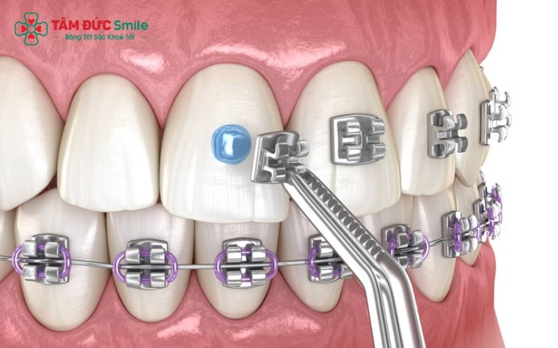Mắc cài đóng vai trò là "điểm giữ" cố định trên răng, kết hợp với dây cung để tạo ra lực kéo giúp răng dịch chuyển về đúng vị trí.