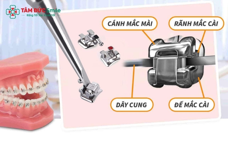 Hệ thống niềng răng là sự phối hợp của nhiều khí cụ khác nhau như mắc cài, dây cung và thun chỉnh nha để đạt hiệu quả tối ưu