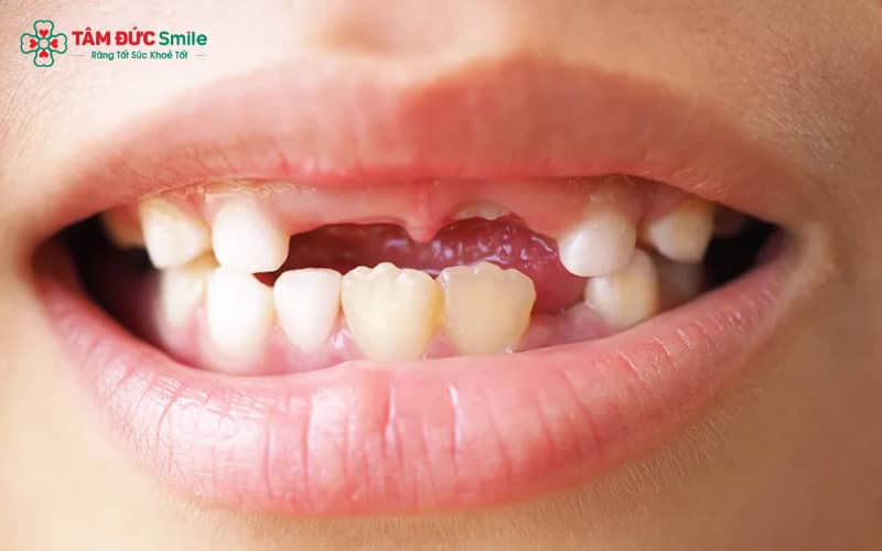 “Một số trường hợp mất răng cửa mới, khớp cắn vẫn ổn định có thể niềng răng bình thường, thậm chí kết hợp implant để tối ưu kết quả