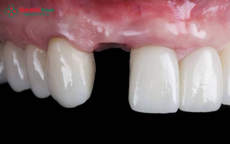“Phim CT ConeBeam giúp đánh giá tiêu xương, khoảng trống và độ ổn định khớp cắn – là các yếu tố quan trọng quyết định có thể niềng răng khi mất răng cửa