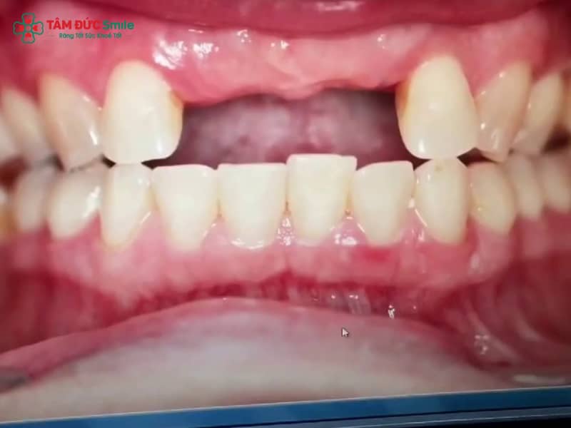 Mất răng cửa có niềng được không? Giải pháp niềng răng khi mất răng cửa hiệu quả