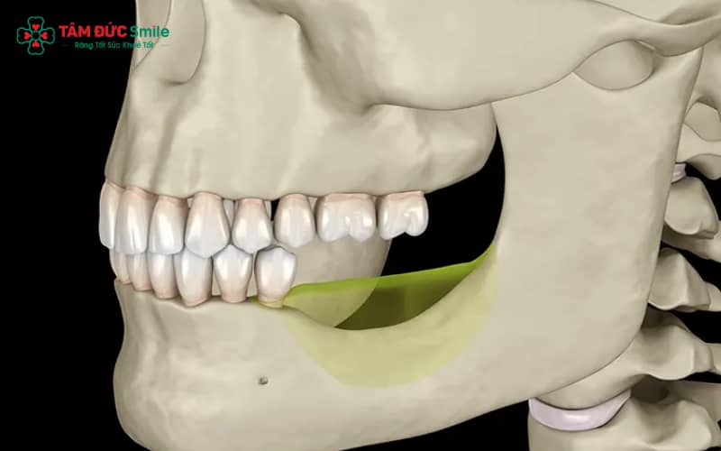 Mất răng lâu năm gây giảm ăn nhai, lệch khớp cắn, tiêu xương hàm và rối loạn phát âm