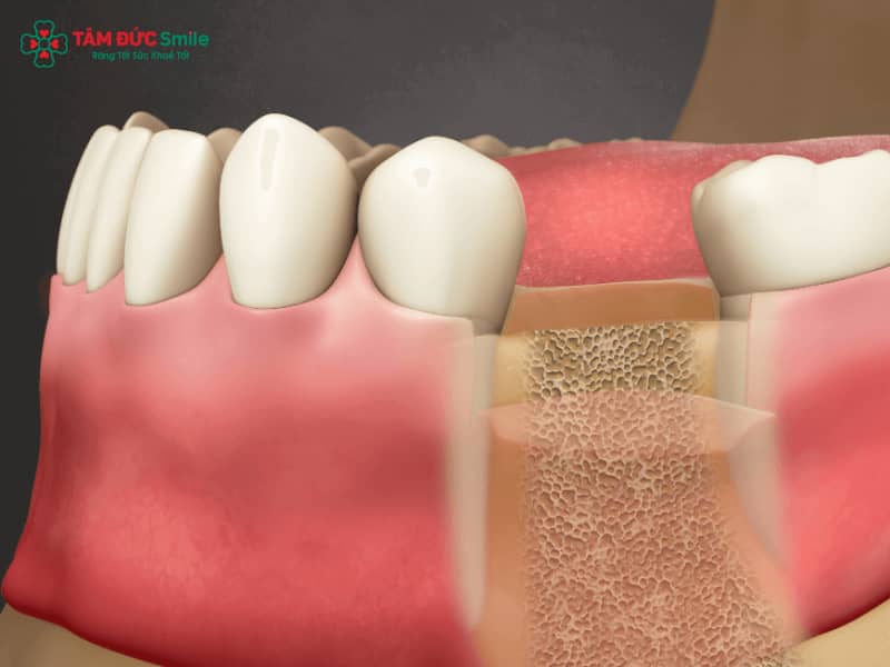 Mất răng hàm có bị hóp má không? Hậu quả tiêu xương hàm, lão hóa sớm, mặt lệch