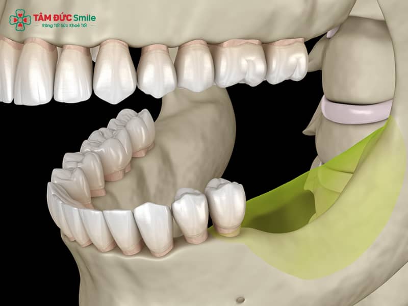 Mất răng hàm có niềng răng được không? Giải pháp niềng răng khi mất răng hàm hiệu quả