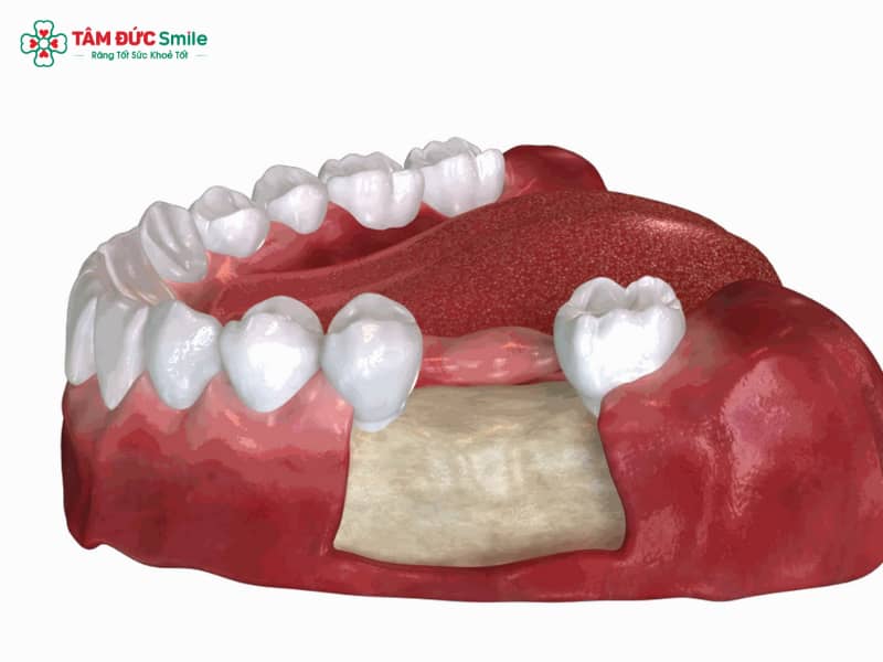 Mất răng lâu năm có trồng được không? Giải pháp Implant và ghép xương hàm hiệu quả