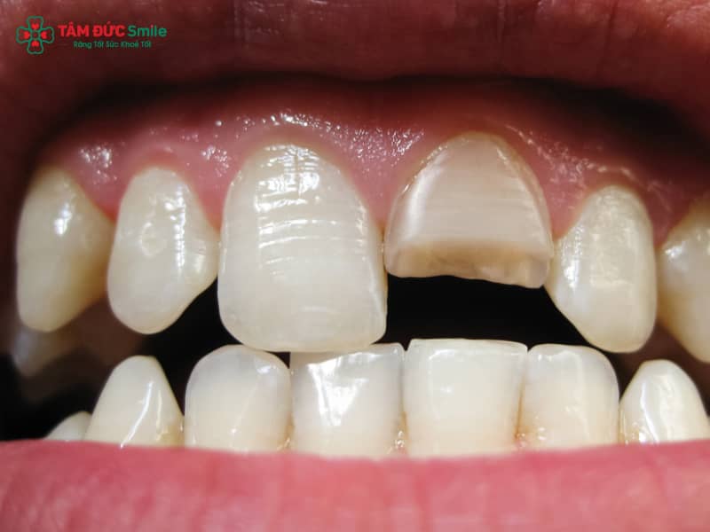 Mất răng nhưng còn chân răng: gãy răng ngang, gãy sát lợi và giải pháp phục hình