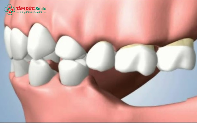 Sâu răng lớn, viêm nha chu, chấn thương hoặc nhổ răng do phục hình hỏng là những nguyên nhân hàng đầu gây mất răng số 6 và 7