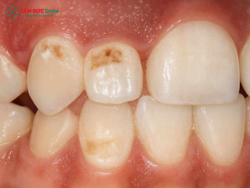 Mòn cổ chân răng là gì? Nguyên nhân, dấu hiệu và cách điều trị hiệu quả