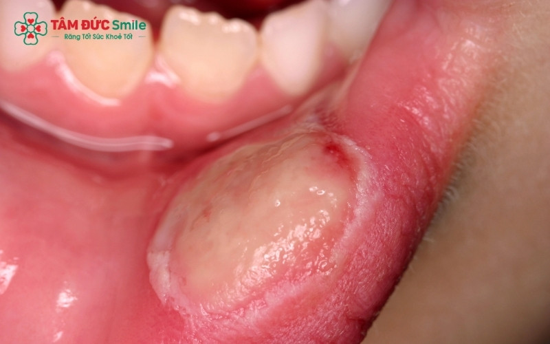  Nhiệt miệng là những vết loét nhỏ có viền đỏ, gây đau rát ở các vị trí niêm mạc mềm như môi, má trong hoặc lưỡi.
