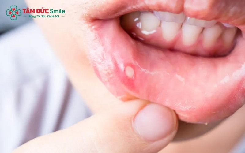 Sự cọ xát của mắc cài niềng răng hoặc dây cung là một trong những nguyên nhân phổ biến gây tổn thương niêm mạc và hình thành nhiệt miệng.