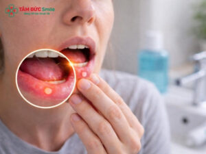 Nhiệt miệng là gì? Nguyên nhân, tác hại và cách điều trị