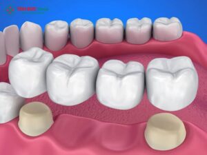 Những trường hợp nên bọc răng sứ để phục hình và cải thiện thẩm mỹ
