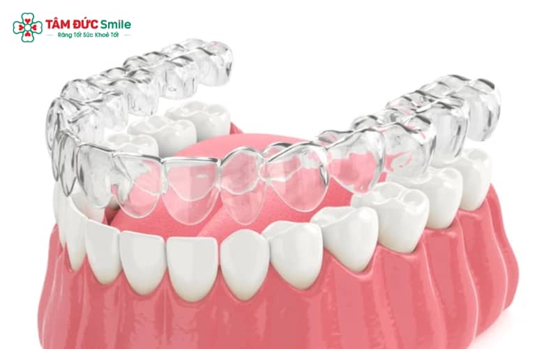 Niềng răng 3D Clear thiết kế dựa trên dữ liệu quét 3D của từng bệnh nhân