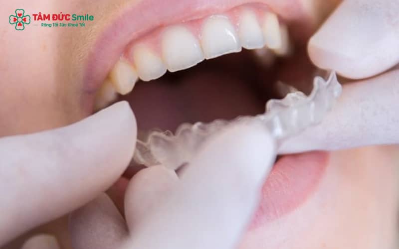 Niềng răng 3D Clear phù hợp với người có răng lệch nhẹ – Invisalign phù hợp cả với ca phức tạp