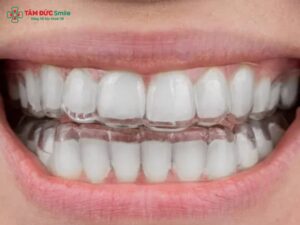 Niềng răng trong suốt có phải nhổ răng không?