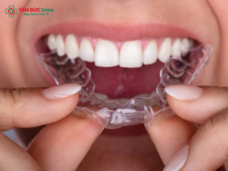Niềng răng trong suốt mất bao lâu để thấy hiệu quả?