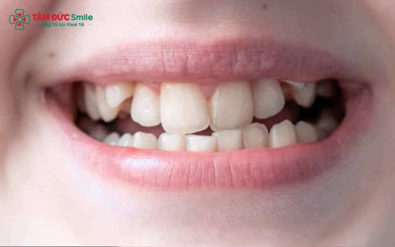 Răng khấp khểnh hình thành do di truyền, mất răng sữa sớm, thói quen xấu hoặc sai lệch khớp cắn bẩm sinh