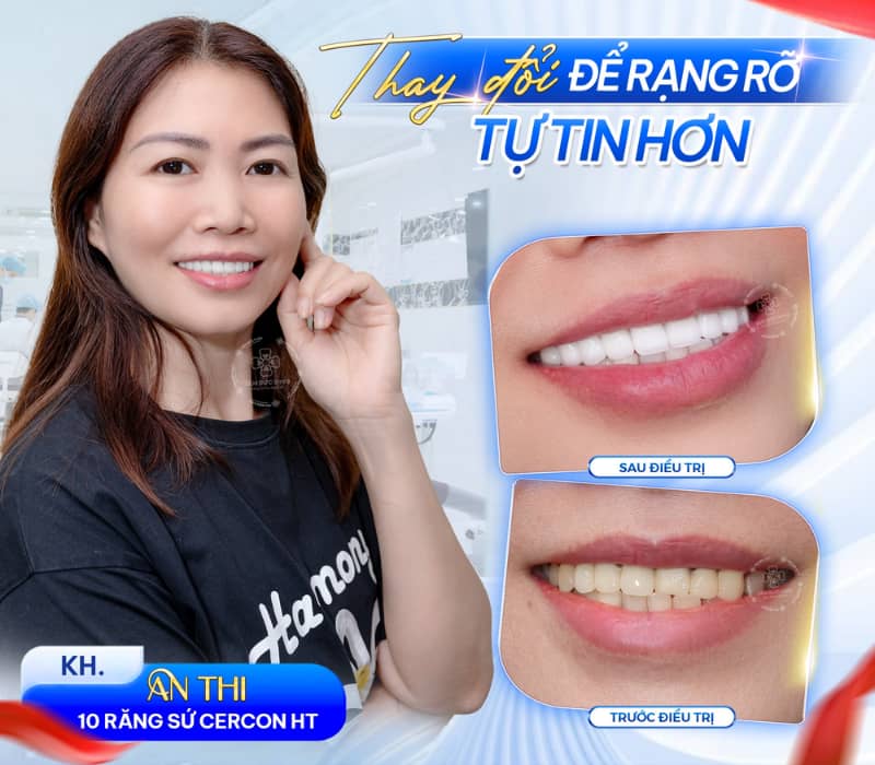 Sau khi dán veneer, cần chăm sóc đúng cách để duy trì độ sáng bóng và tuổi thọ của răng sứ