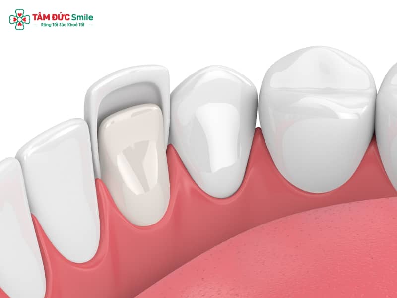 Răng không đều có dán sứ được không? Giải pháp veneer thẩm mỹ