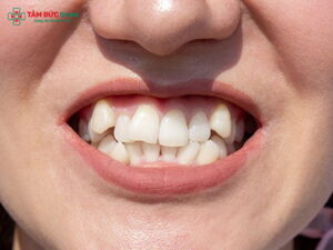 Răng mọc lệch có bọc sứ được không?Giải pháp thẩm mỹ nhanh