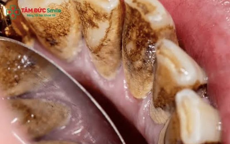 Có rất nhiều nguyên nhân khiến răng đổi màu, từ thói quen ăn uống, hút thuốc lá cho đến việc vệ sinh chưa đúng cách gây tích tụ mảng bám
