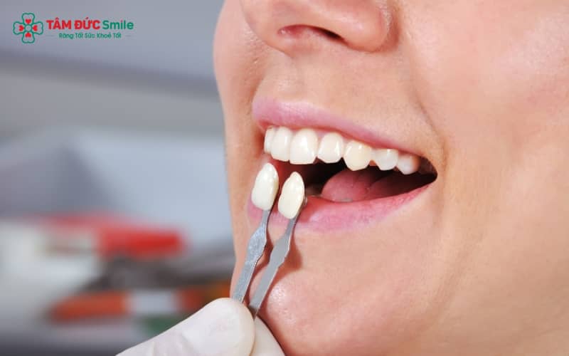 Răng sâu nhẹ, còn đủ mô răng thật vẫn có thể dán sứ veneer sau khi điều trị triệt để phần sâu