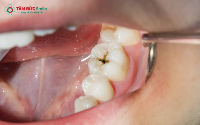 Duy trì vệ sinh răng miệng đúng cách giúp răng sứ bền đẹp và ngăn ngừa tái phát sâu răng