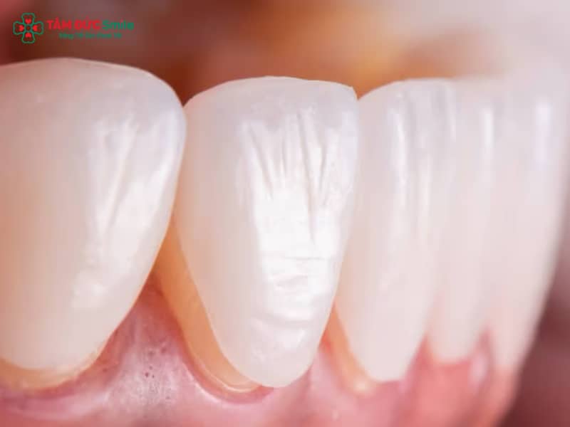 Răng sâu có dán sứ được không? Giải pháp phục hình thẩm mỹ hiệu quả