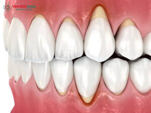 Tại sao răng sứ bị hở nướu? Nguyên nhân & cách khắc phục hiệu quả