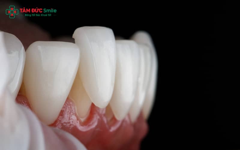 Răng sứ bị lỏng có thể do keo dán kém chất lượng, kỹ thuật gắn không chuẩn, răng thật yếu hoặc lực nhai quá mạnh