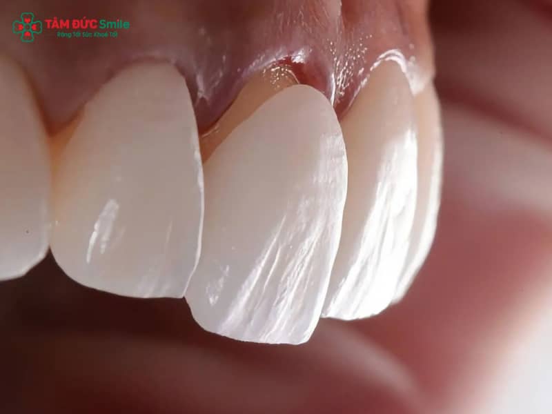 Nguyên nhân răng sứ bị lỏng và cách khắc phục hiệu quả
