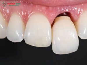 Răng sứ bị lung lay phải làm sao? Cách xử lý an toàn