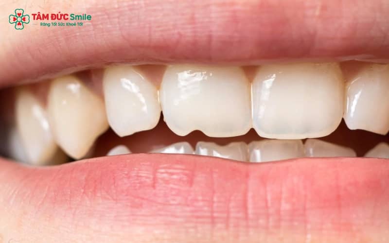 Răng sứ bị mẻ thường do lực nhai mạnh, nghiến răng, va chạm hoặc sử dụng vật liệu sứ kém chất lượng