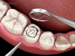 Răng sứ bị mẻ có trám được không? Cách khắc phục hiệu quả, bền đẹp