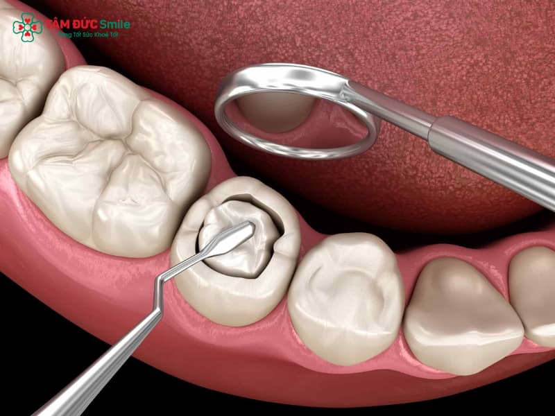 Răng sứ bị mẻ có trám được không? Cách khắc phục hiệu quả, bền đẹp